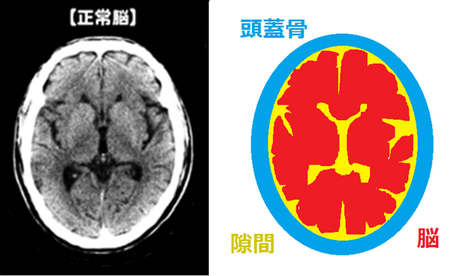 高齢者の正常な脳の画像