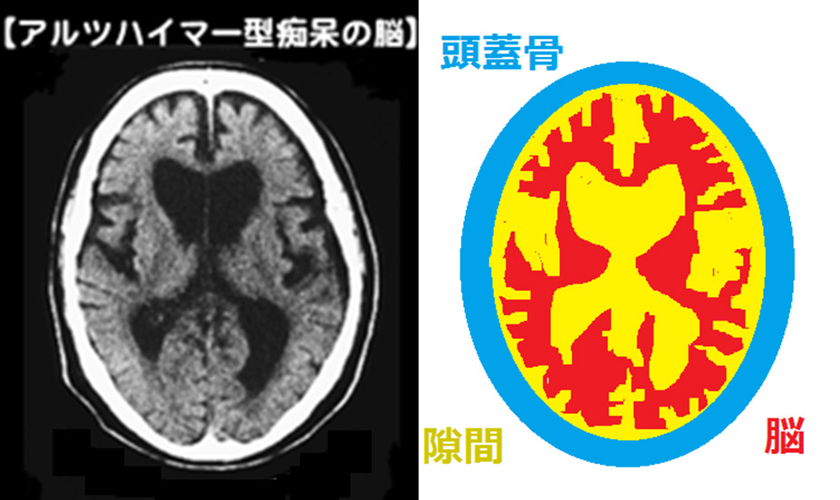 アルツハイマー型痴呆の脳