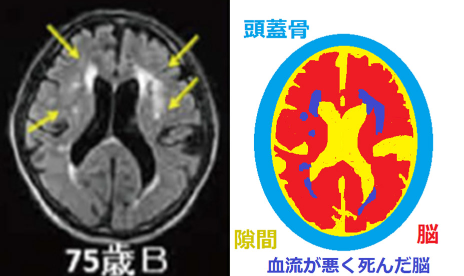 糖尿病と高血圧で動脈硬化が進んだ方の脳画像